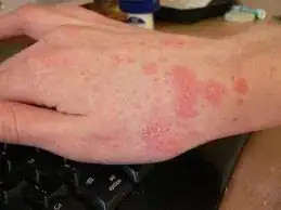 Scabies picture 5