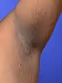 Acanthosis nigricans, klinisch