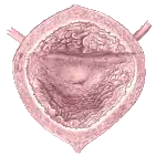 Links: Schematische Darstellung der anatomischen Verhältnisse zwischen Harnblase und Harnröhre, Rechts: Blick aus dem Inneren der Harnblase, dem Trigonum vesicae und als dem Ursprungsort der Urethra die zentral liegende Öffnung der inneren Harnröhrenmündung (Ostium urethrae internum)