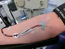 Aus-/Einlass-Kanüle mit Luer-Lock in der rechten Armbeuge, mit Nadelschutz und Schlauchklemme