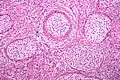 Brenner-Tumor