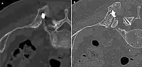 Während der RFA: A) Die HF-Elektrode wurde direkt in die Knochenmetastase geführt. B) Nach der Ablation wurde eine Mischung aus Knochenzement und Bariumsulfat in den entstandenen Freiraum injiziert.