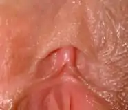 Klitoris ohne Verklebung: Die Vorhaut ist frei verschieblich, die ganze Eichel ist sichtbar. Die sich in beide kleinen Labien aufzweigenden Frenula clitoridis auch gut sichtbar.