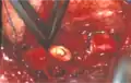 Aortenisthmusstenose – intraoperatives Bild  nach Resektion der Engstelle