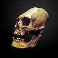 Deformierter und trepanierter Schädel