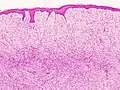Rezidiv eines Dermatofibrosarcom protuberans HE-Färbung.