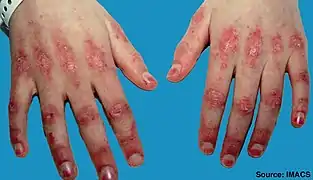 Gottron-Papeln der Fingergelenke