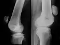 Differentialdiagnose Riss der Patellarsehne: Zeichen im Röntgenbild: Hochstand der Patella.