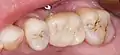 Eingesetzte verschraubte Implantatkrone in Regio 26 (Aufsicht)