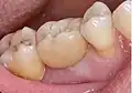 Eingesetzte verschraubte Implantatkrone in Regio 26 (Seitenansicht)