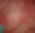 normales Endometrium