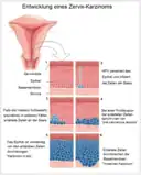 Entwicklung eines Zervixkarzinoms nach Penetration von HPV. Stadium 6: Penetration des Karzinoms in benachbartes Gewebe.