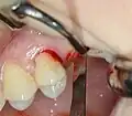 Externer Sinuslift mit Implantation Regio 26 – Kieferkammschnitt und Sulcusschnitt