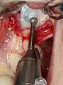 Externer Sinuslift mit Implantation Regio 26 – Präparation bukkales Knochenfenster Sinus