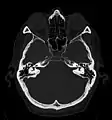 Craniale Computertomographie Abgebildet sind Felsenbein und Nasennebenhöhlen. Aufgrund der hohen Auflösung der Aufnahme des verwendeten 64-Zeilen-CTs sind selbst die Gehörknöchelchen erkennbar.