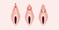 Darstellung verschiedener Piercings durch die Klitorisvorhaut oder in deren unmittelbaren Umgebung: Vertikales (links) und horizontales Klitorisvorhautpiercing (Mitte), Triangle-Piercing (rechts)