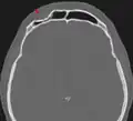 Impressionsbruch der Stirnhöhle in der Computer­tomo­graphie (Pfeil). Die hintere Stirnhöhlenwand zum Hirnschädel ist hier nicht betroffen.