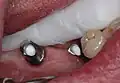 Eingeschraubte Abutments auf Implantaten kurz vor Einsetzen einer Implantatbrücke