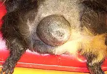 Tumor