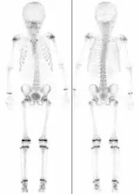 Skelettszintigrafien bei zwei Kindern, links 7 Jahre, rechts 15 Jahre alt (nicht maßstabsgerecht). Jeweils intensiver Knochenstoffwechsel in den Wachstumsfugen.