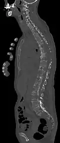 Sagittal rekonstruierte CT, Darstellung im Knochenfenster. Da die Patientin multiple Metastasen in allen Körperregionen hatte, konnte sie die Arme nicht für die Untersuchung nach oben nehmen, weshalb die Hände mit abgebildet sind.