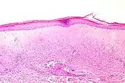 Histologie eines atrophen Lichen sclerosus.
