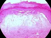 Lichen sclerosus (hypertrophische Form)