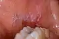 Wickham striae