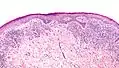 Lichen ruber planus mit weniger stark ausgeprägter Akanthose