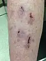 Lichen planus über dem Schienbein, hier mit Ulzerationen