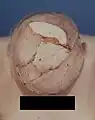 Revision mit tiefgreifender Tumorresektion und Verschluss der Operationswunde mit einem myokutanen Hautlappen des Musculus latissimus dorsi.