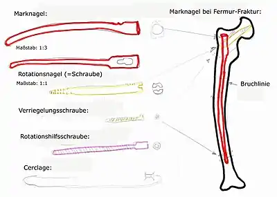 Marknagel im Oberschenkelknochen