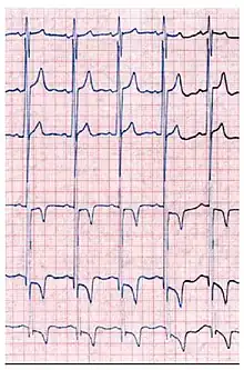 Das EKG eines Morbus-Fabry-Patienten zeigt eine linksventrikuläre Hypertrophie mit erhöhtem Sokolow-Lyon-Index, reduzierter ST-Strecke und negativen T-Wellen in den linken EKG-Ableitungen.