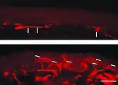 Fluoreszenzmikroskopaufnahmen eines Gefrierschnittes der Haut eines Morbus-Fabry-Patienten.Auffällig ist der Mangel an intraepidermalen Nervenfasern und das Vorhandensein von Fasern, die zum subepidermalen Nervenplexus gehören (Pfeile). Die untere Hautprobe stammt dagegen vom Rücken des Patienten. Hier ist die dichte Innervation der Epidermis (Pfeile) auffällig.