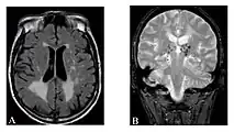 Hyperintensitäten der weißen Hirnsubstanz, lakunare Hirninfarkte und Mikroblutungen.A) Die axiale MRT zeigt vielfältige Läsionen der weißen Hirnsubstanz in der zerebralen Hemisphäre eines 53-jährigen männlichen Patienten mit einem Fazekas-Score von 3.B) Lakune und Mikroblutungen bei demselben Patienten.