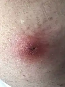 typical `boil`containing the maggot of Cordylobia antropophaga in human skin