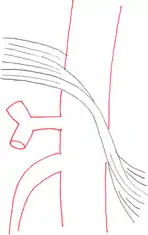 Schematische Darstellung: links der anatomische Normalbefund, das Ligamentum arcuatum medianum liegt oberhalb des Abganges der Arteria coeliaca; rechts gut zu erkennen, wie das Ligamentum das Gefäß einschnürt.