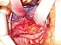 Oesophagusresektion mit Magenhochzug nach Fertigstellung der Anastomose intrathorakal