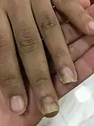 Nagelpilzbefall an Mittel- und Ringfinger