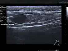 Ultraschallbild einer Schilddrüse vom Hund mit Adenom der Nebenschilddrüse