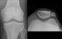 Differentialdiagnose Patella bipartita: Im Gegensatz zur Längsfraktur (s. unten) abgerundete Kanten der Fragmente