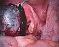 Eröffnete Endometriosezyste des linken Eierstocks