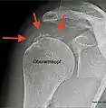Tendinosis calcarea im Resorptionsstadium