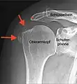 Tendinosis calcarea in der Resorptionsphase mit Bursitis (waagerechter Pfeil)