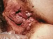 Feigwarzen der Vulva.