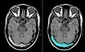 Thrombose (im rechten Bild blau hervorgehoben) in den Sinus transversi im axialen T1w-Schnittbild einer MRT.