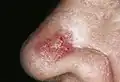 Sklerodermiformes Basaliom (Morphea-Basaliom)