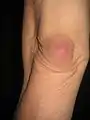 Bursitis am Ellbogen, völlig schmerzfrei, nur ein Spannungsgefühl beim Beugen