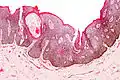 Alterswarze, histologisch