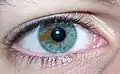 Iris mit lokaler Pigmentstörung(sog. „sektorielle Heterochromie“)
